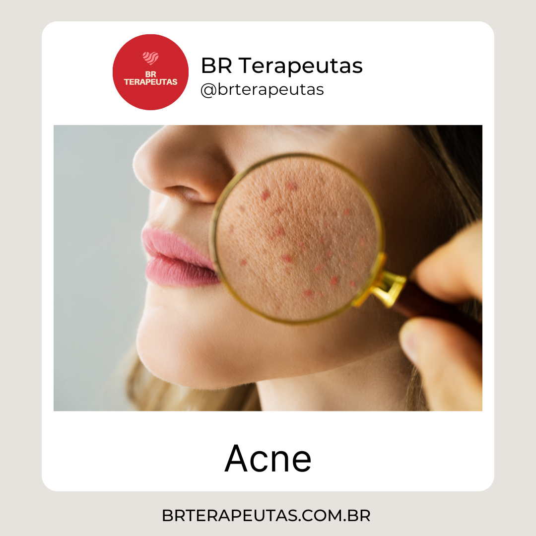 Ilustração explicativa sobre o que é acne, mostrando a pele com exemplos de espinhas e inflamações