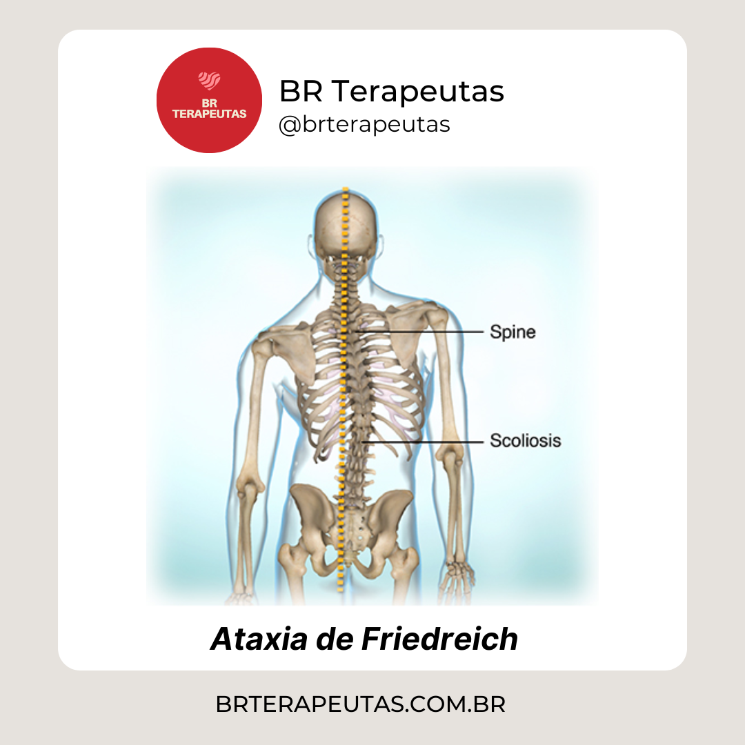 Foto do esqueleto da doença da ataxia de Friedreich