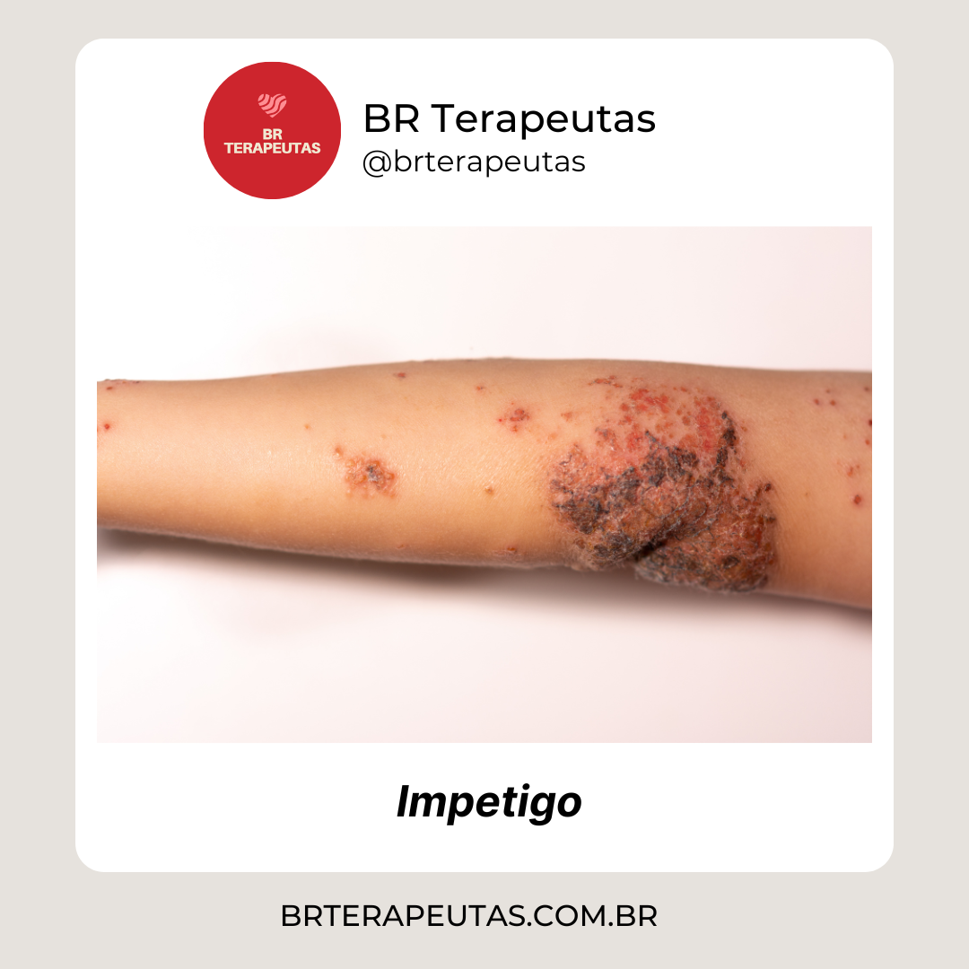 O que é impetigo - foto de um braço de criança com impetigo