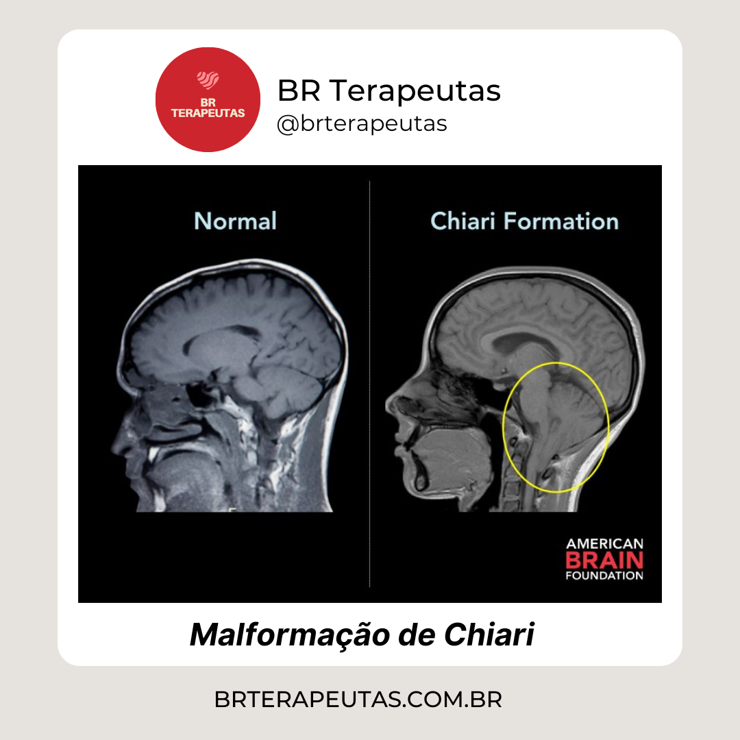 Malformação de Chiari - Foto de um cérebro com a malformação