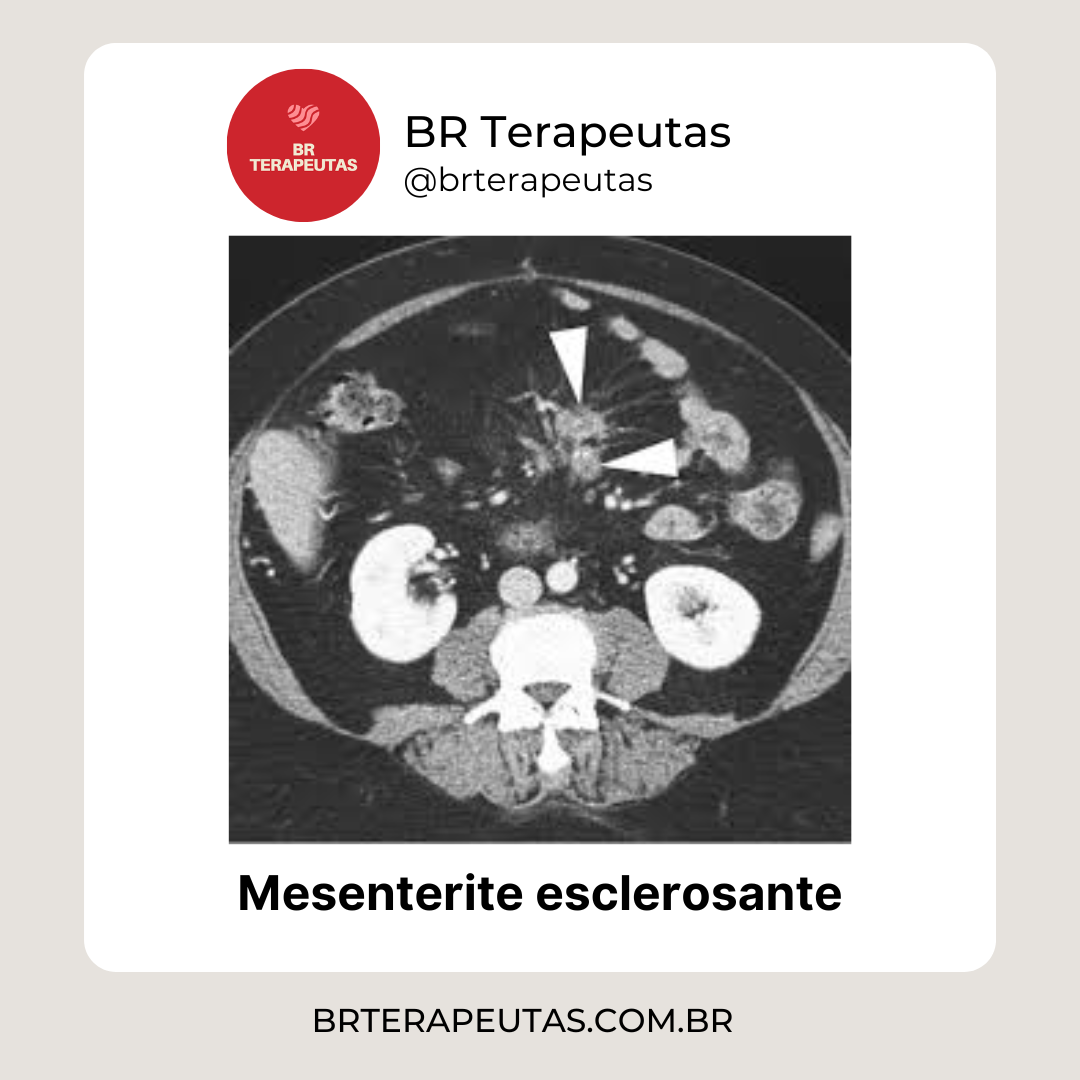 A mesenterite esclerosante é uma condição inflamatória crônica que afeta o mesentério