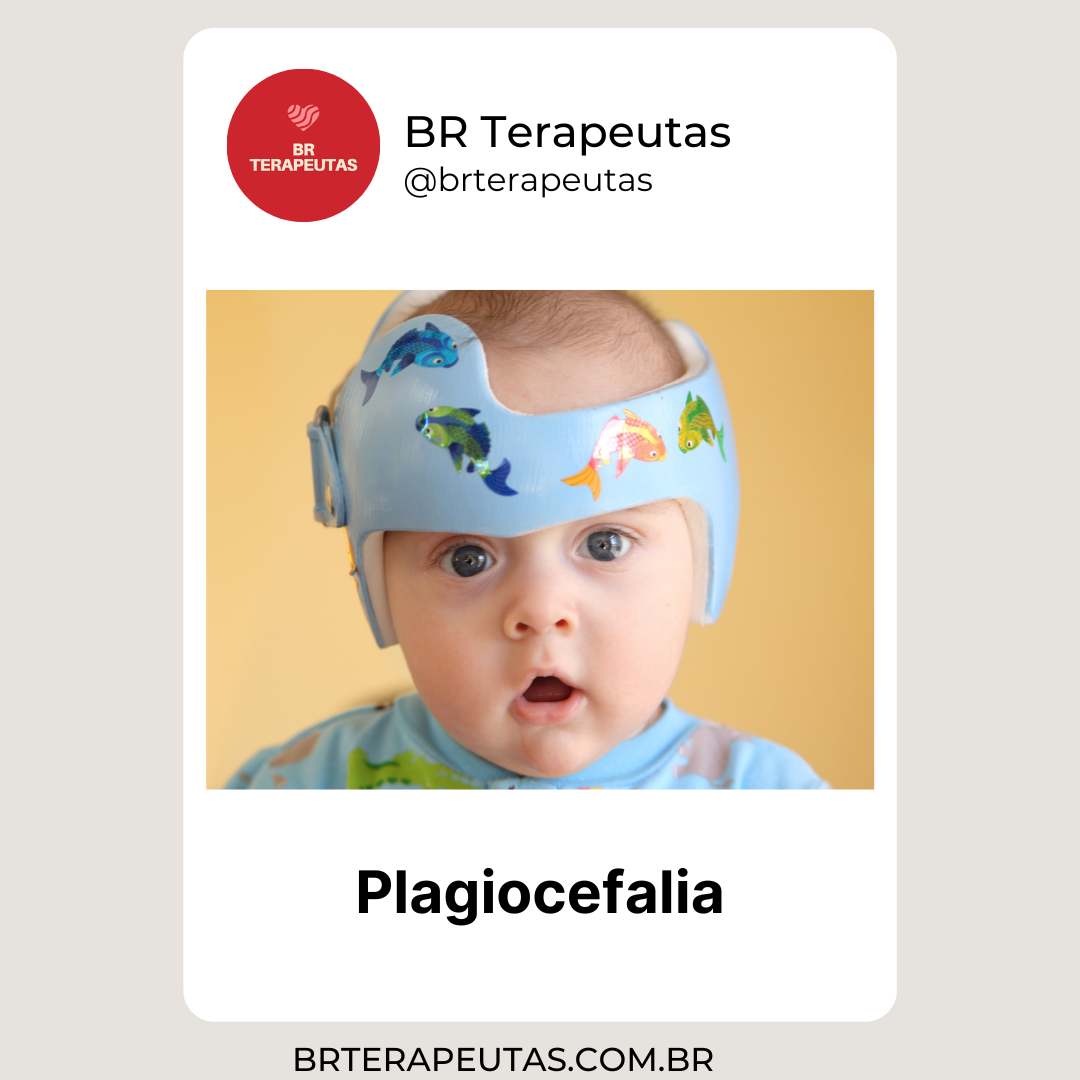 O que é Plagiocefalia e braquicefalia