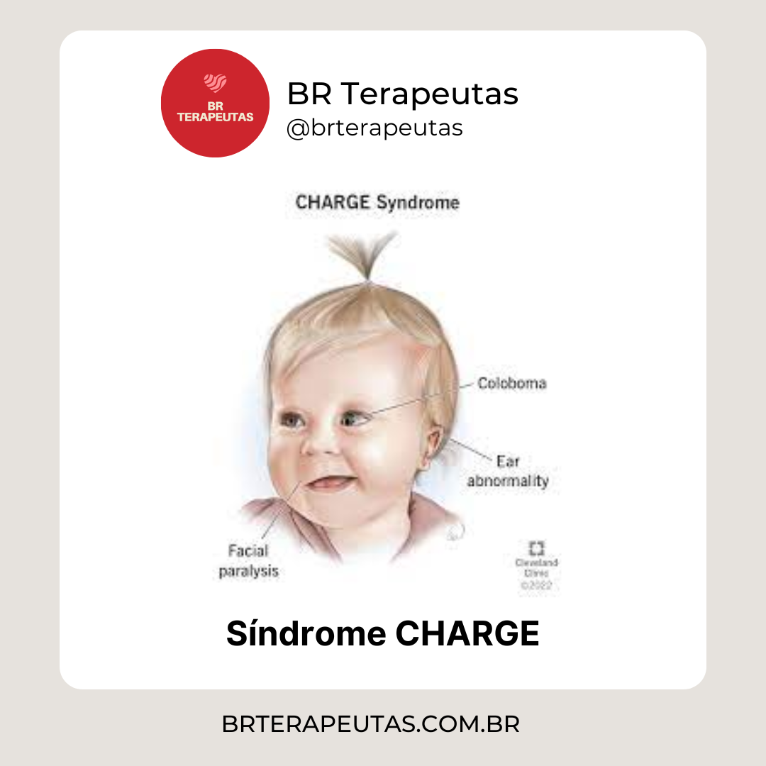 Síndrome CHARGE - foto de uma criança com síndrome CHARGE Mayo clinic