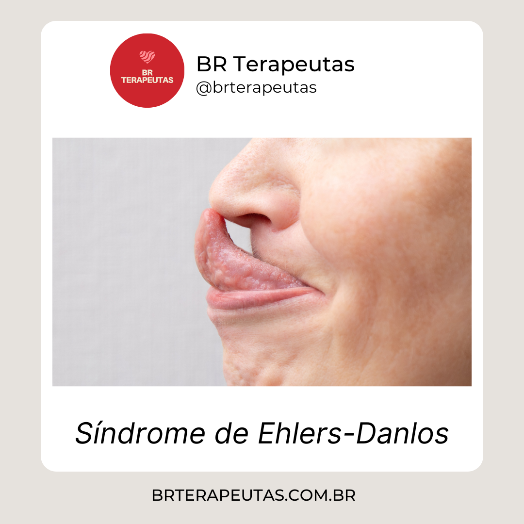 Síndrome de Ehlers-Danlos é um grupo de doenças hereditárias que afetam os tecidos conjuntivos - BR Terapeutas