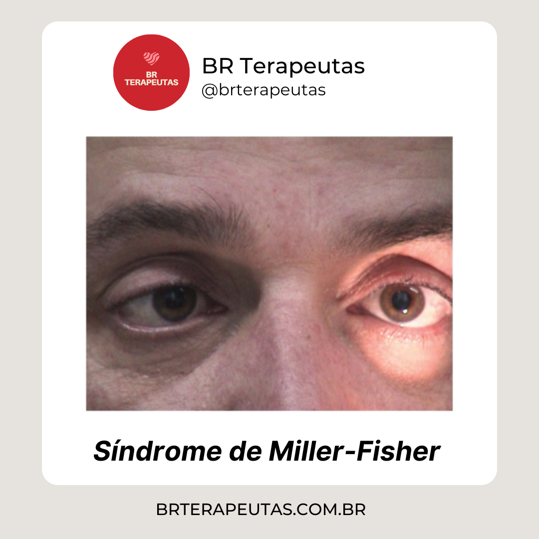 A síndrome de Miller-Fisher é uma doença rara que faz com que o sistema imunológico
ataque os nervos