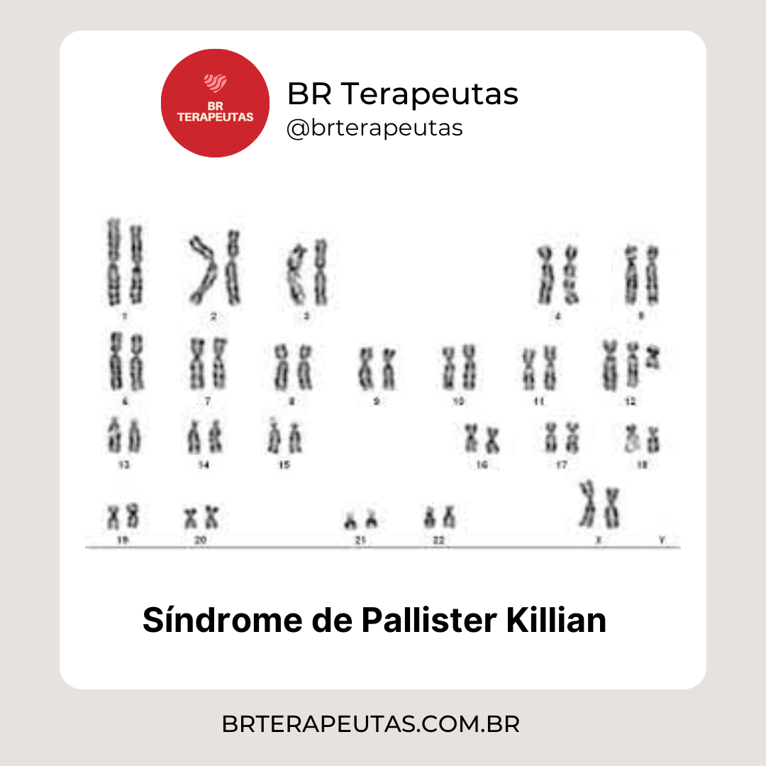 O que é a Síndrome de Pallister Killian - foto da síndrome de Pallister-Killian com
47 cromossomos