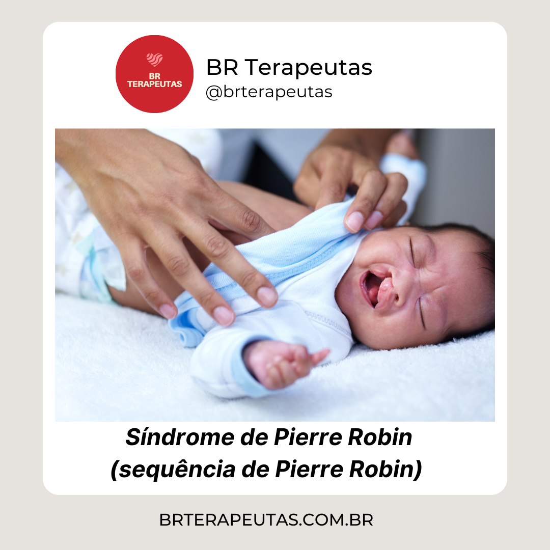 Sequência de Pierre Robin - Foto de um bebÊ com fenda palatina