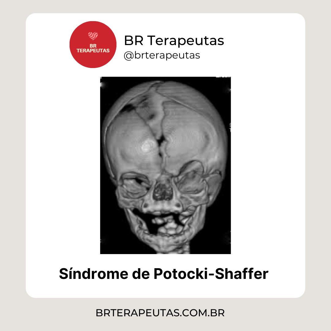 Informações sobre a Síndrome de Potocki-Shaffer - foto de um crânio ampliado